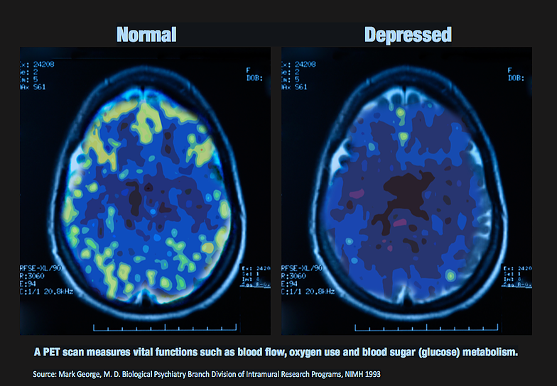 depression-makes-your-brain-aging-faster